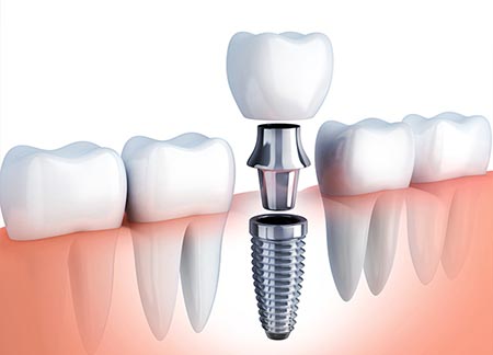 Dental Implants