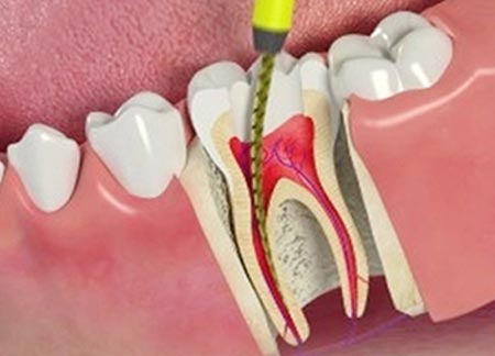 ROOT CANAL TREATMENT